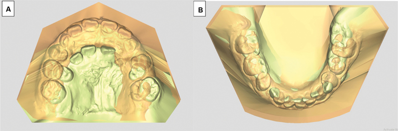 The Characteristic of Transverse Dental Arch Relationship Study in Unilateral Cleft and Palate versus Noncleft in Thai Northeastern Population.