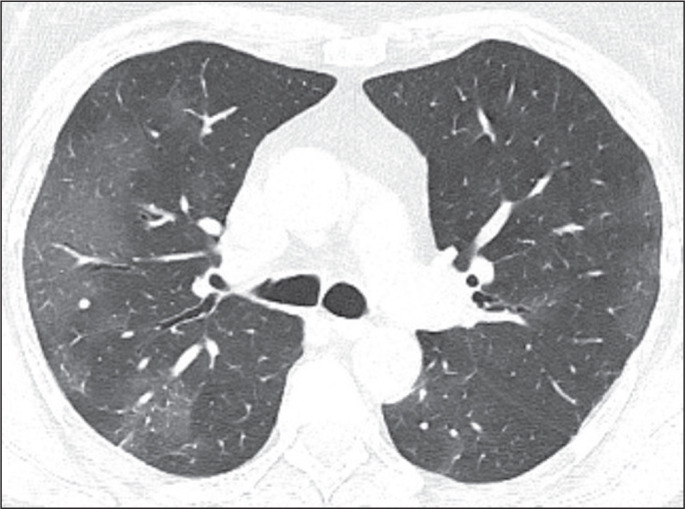 Relationship between the computed tomography pattern and vaccination status in individuals with COVID-19.