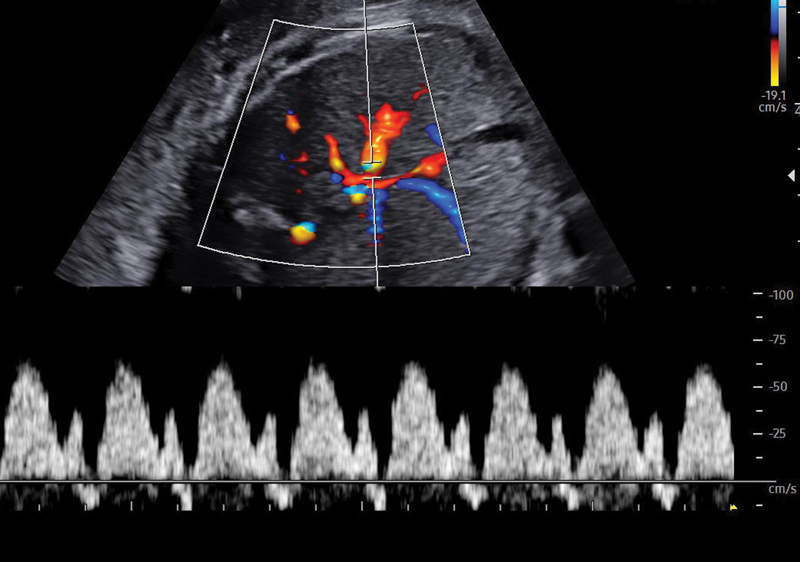 Fetal Growth Restriction: A Pragmatic Approach.