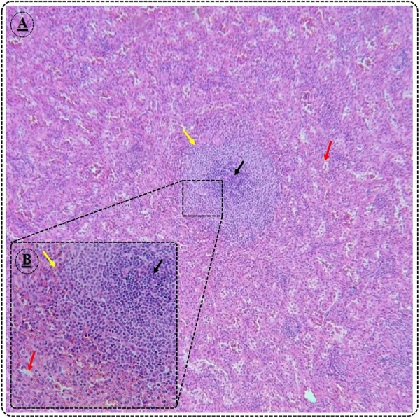 Pelvic splenosis implanted in Douglas pouch mimics pseudo-endometriosis symptoms: a case report study.