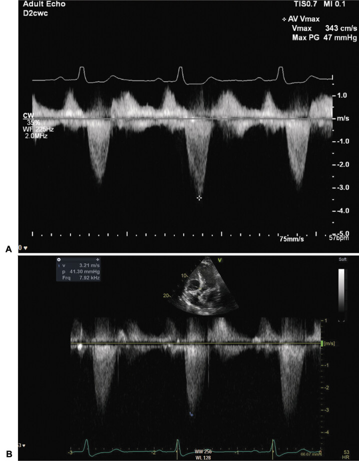 Transthoracic Echocardiogram Guided Hemodynamic Management to Maintain Cerebral Perfusion in an Extracranial-Intracranial Bypass Case: Case Report.