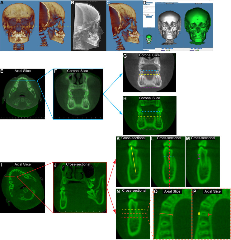 Transverse dentoalveolar changes of mandibular canine and premolar regions after lip bumper therapy: a retrospective CBCT study.
