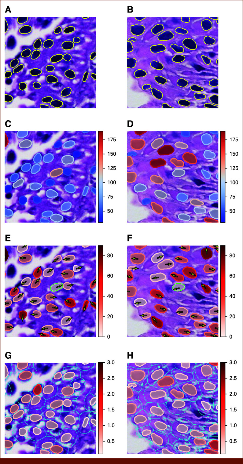 Computational Morphological Assessment of Bladder Cancer Tissue Is Prognostic of Recurrence and Overall Survival Following Transurethral Resection.