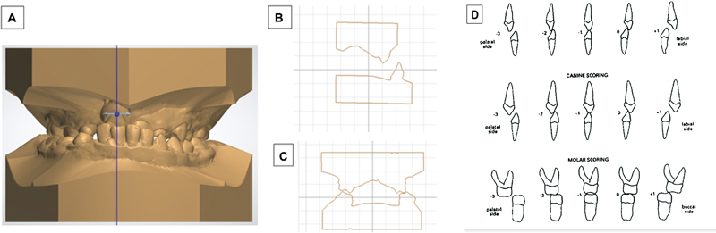 The Characteristic of Transverse Dental Arch Relationship Study in Unilateral Cleft and Palate versus Noncleft in Thai Northeastern Population.