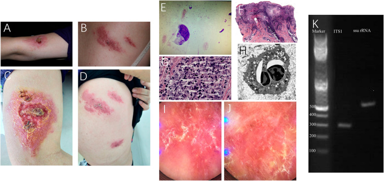 Integrated diagnosis and successful treatment of imported old world cutaneous leishmaniasis with intralesional sodium stibogluconate in china: a case report.