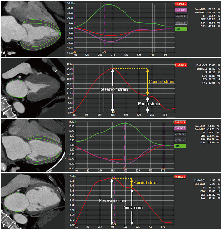 Impact of Aortic Stenosis Severity on Left Heart Function Analyzed Using CT-Derived Strain Parameters.