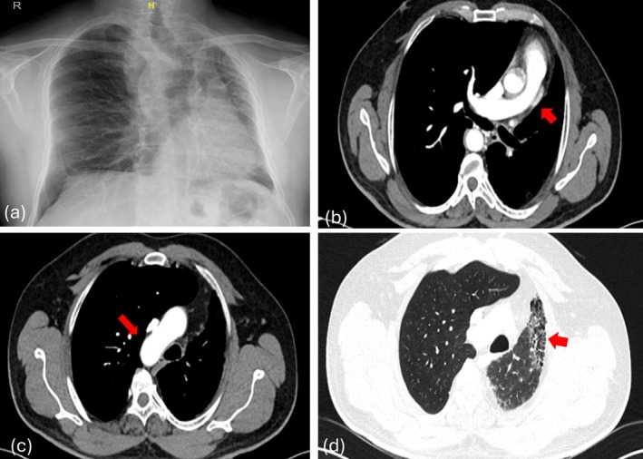 Breathing With Half a Pulmonary Circuit: Three Cases of Unilateral Pulmonary Artery Agenesis.