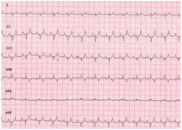 Transient Extreme Axis Deviation in a Dog With Diabetic Ketoacidosis.