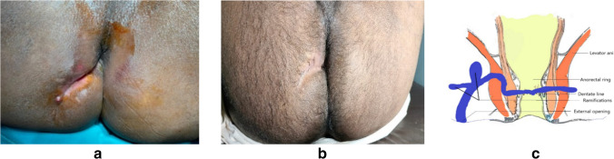 IFTAK (Interception of Fistulous Tract with Application of Ksharasutra) technique: a minimally invasive solution for recurrent fistula-in-ano-a case series analysis.