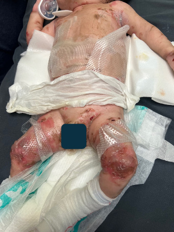 Infant Spinal Anesthesia for Urologic Surgery in a Patient With Epidermolysis Bullosa.