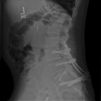 Outcomes of Percutaneous Versus Open Lumbopelvic Fixation of Spinopelvic Dissociation.