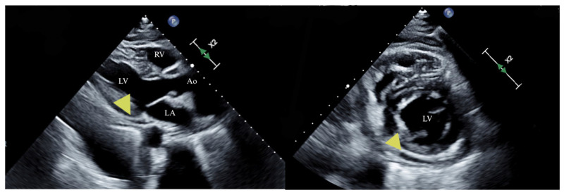 Beyond Atrial Fibrillation and Heart Failure: Ibrutinib-induced Pericardial Effusion.