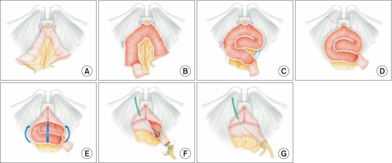 Totally intracorporeal ileal neobladder following robot-assisted radical cystectomy in male patients using the Juntendo technique: Initial experience.