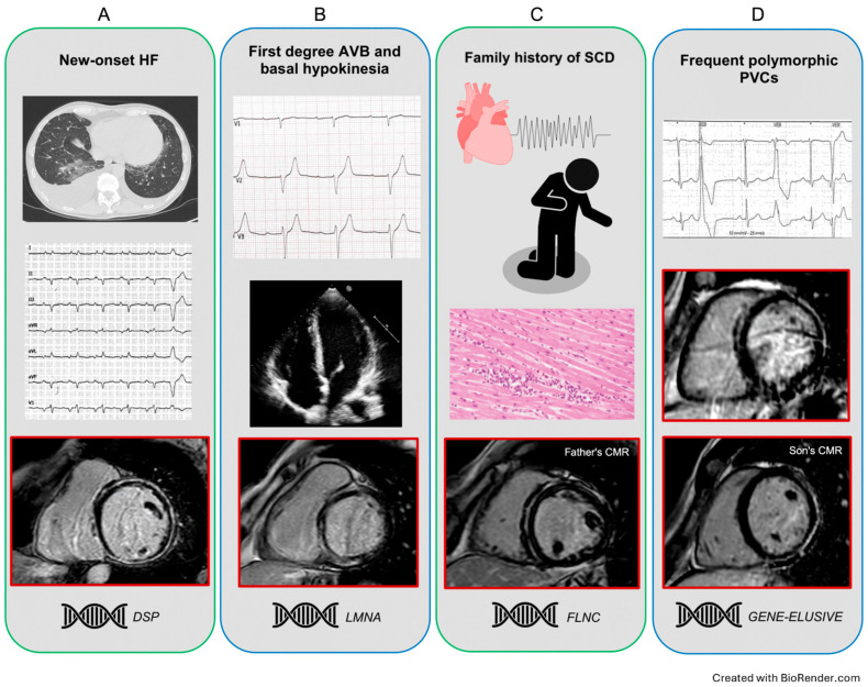 Left Ventricular Ring-like Pattern: The Arrhythmic Tale of a Scarred Heart.