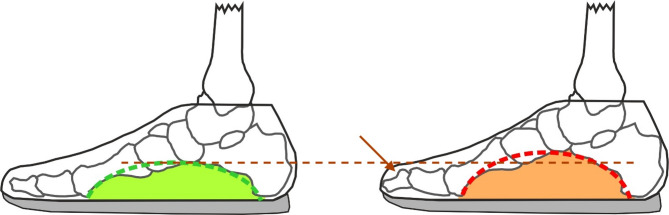 A potential relationship between soccer shoes and pes cavus: a pilot study.