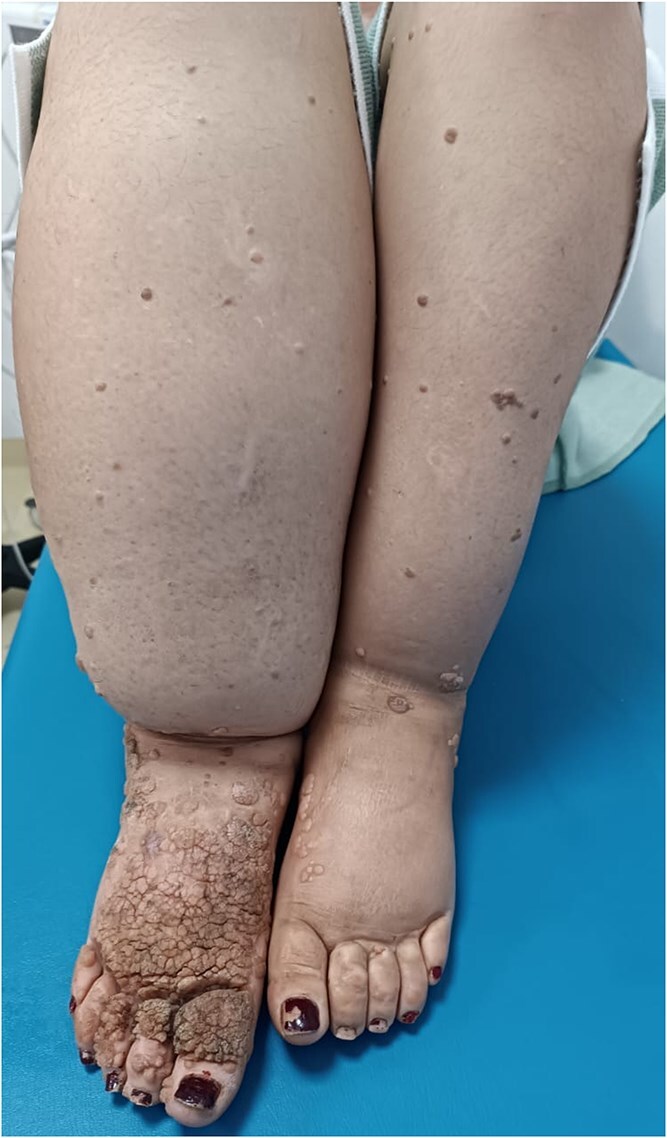 A case of classic epidermodysplasia verruciformis associated with elephantiasis: an atypical presentation.