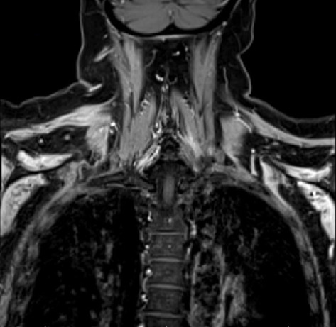 Bilateral Parsonage-Turner Syndrome in a Patient With Hemophagocytic Lymphohistiocytosis.
