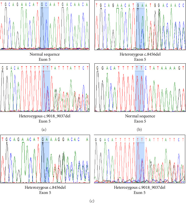 Pontocerebellar Hypoplasia Type 3 With Two Novel <i>PCLO</i> Gene Mutations: A Case Report.