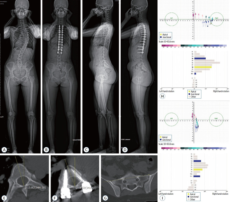 Efficacy Comparison of Multiplanar Deformity Reducer System and Direct Vertebral Rotation in Adolescent Idiopathic Scoliosis Corrective Surgery.