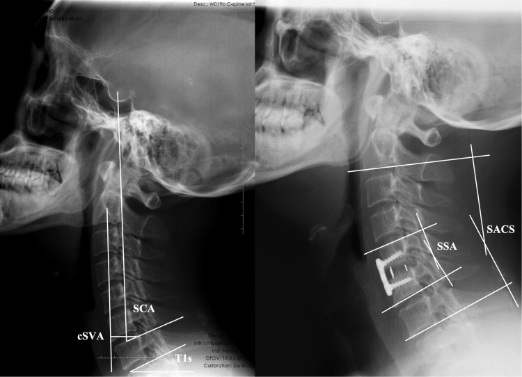 Preoperative Spino Cranial Angle Predicts Adjacent Segment Degeneration After Single-Level Anterior Cervical Discectomy and Fusion.