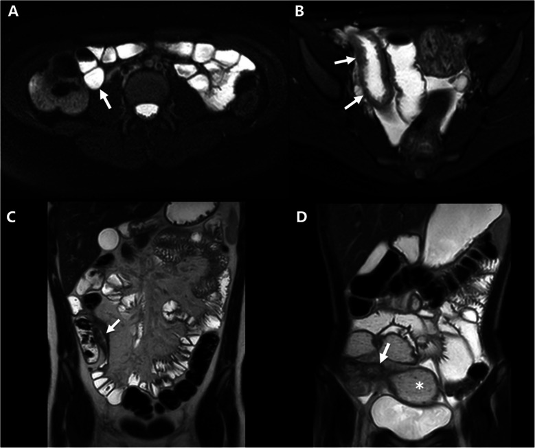 Baseline terminal ileal CT and MRI measurements are associated with imaging outcomes in pediatric Crohn's disease: a cohort study.
