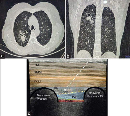 An Approach to Intraoperative Accidental Pulmonary Artery Transection and Role of Mid-Point to Transverse Process Interfascial Plane Block.
