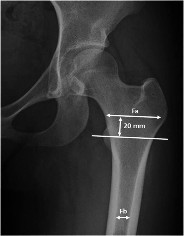 Older Patients Undergoing Bipolar Hemiarthroplasty Face a Higher Risk of Intraoperative Fractures and Longer Hospital Stays on Delayed Surgery After Injury: A Multicenter Study.