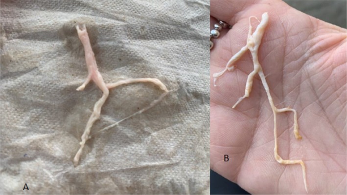 Rare Adult Case of Plastic Bronchitis in an Otherwise Healthy Adult.