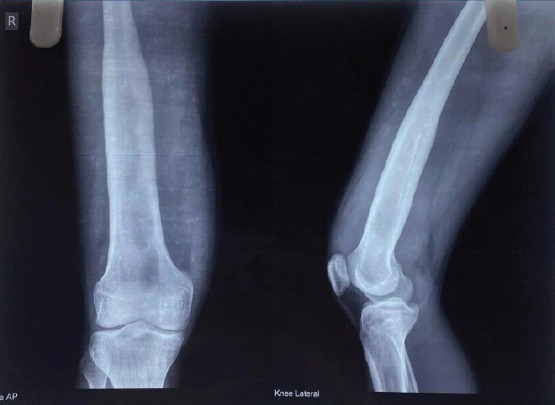 A Case Report of Acute on Chronic Osteomyelitis of Distal Femur Managed with Sequestrectomy, Saucerization, and Stimulan Placement.