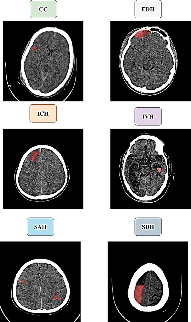 Advanced multi-label brain hemorrhage segmentation using an attention-based residual U-Net model.