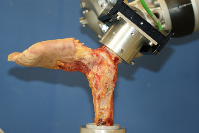 Biomechanical testing of lateral and medial ligament reconstruction using bone anchors with autologous resident tissue: influence of different reconstruction techniques on stability and mobility.