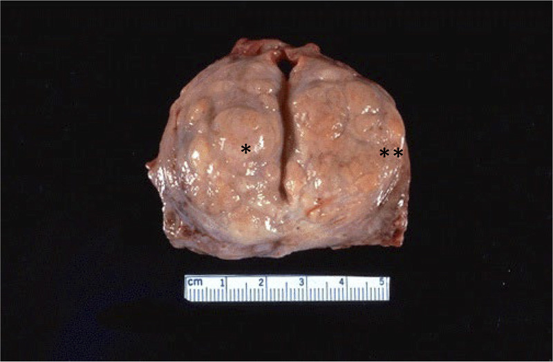 Emphasis on the management of embedded capsular hyperplasia nodules associated with benign prostatic hyperplasia.