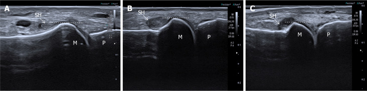 First metatarsophalangeal joint synovial hypertrophy associated with vitamin D status in type 2 diabetes mellitus: An ultrasound-graded study.
