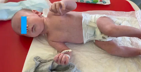 Severe Hypocalcemia Dependent on Fluconazole in a Newborn With Barakat Syndrome.