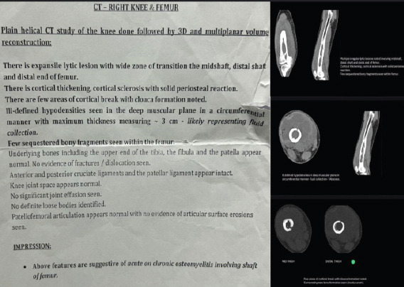 A Case Report of Acute on Chronic Osteomyelitis of Distal Femur Managed with Sequestrectomy, Saucerization, and Stimulan Placement.