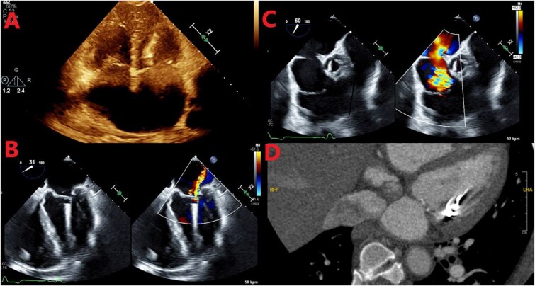 Silent misplacement: leadless pacemaker in the left ventricle discovered over a year later-How did it end up there? Could it explain the stroke?