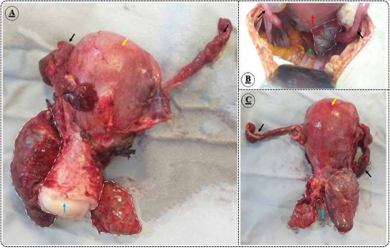 Pelvic splenosis implanted in Douglas pouch mimics pseudo-endometriosis symptoms: a case report study.