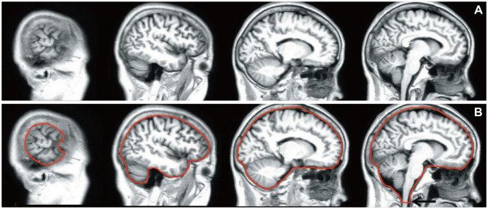 Current Clinical Applications of Structural MRI in Neurological Disorders.