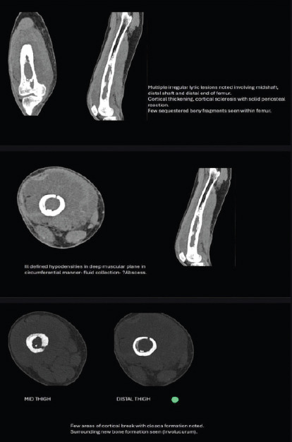 A Case Report of Acute on Chronic Osteomyelitis of Distal Femur Managed with Sequestrectomy, Saucerization, and Stimulan Placement.