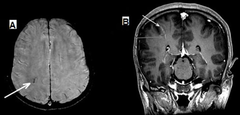 Detection of venous angiomas on susceptibility enhanced magnetic resonance imaging in patients with seizures.