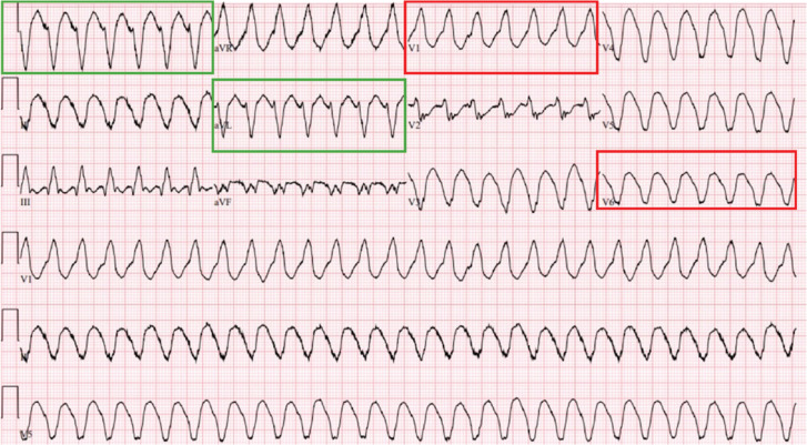Electrogram Dynamics at the Site of Ventricular Tachycardia Termination During Radiofrequency Ablation.