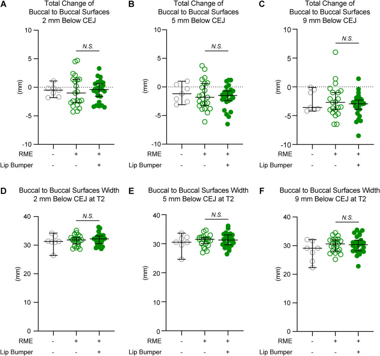 Transverse dentoalveolar changes of mandibular canine and premolar regions after lip bumper therapy: a retrospective CBCT study.