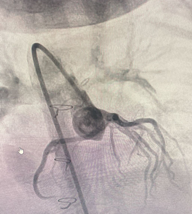 A rare case of coronary artery bypass grafting in pediatric cardiac surgery: emphasizing the importance of internal thoracic artery usage.