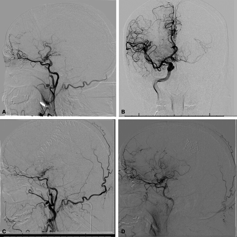 Transthoracic Echocardiogram Guided Hemodynamic Management to Maintain Cerebral Perfusion in an Extracranial-Intracranial Bypass Case: Case Report.