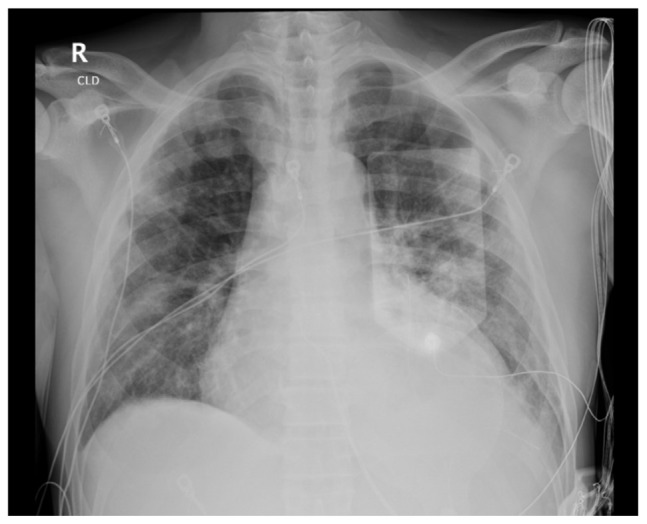 Beyond Atrial Fibrillation and Heart Failure: Ibrutinib-induced Pericardial Effusion.