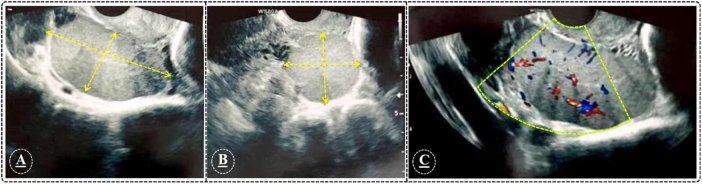 Pelvic splenosis implanted in Douglas pouch mimics pseudo-endometriosis symptoms: a case report study.