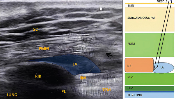 Effectiveness of Pecto-Intercostal Fascia Plane Block in Reducing Total Postoperative Opioid Consumption in Cardiac Surgery Involving Sternotomy: A Meta-Analysis.