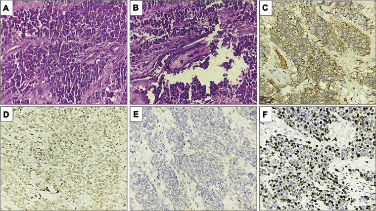 Ewing's Sarcoma of the Frontal Bone with Intracranial Extension.