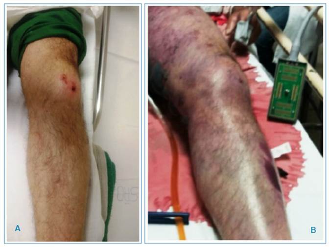 Secondary infection with Aeromonas hydrophila and death of two patients with probable Bothrops envenomation.