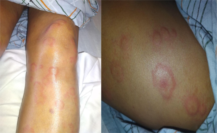 Leukocytoclastic Vasculitis in JAK2-Positive Essential Thrombocythemia: A Case of Cytokine-Driven Urticarial Rash Responsive to Ruxolitinib.